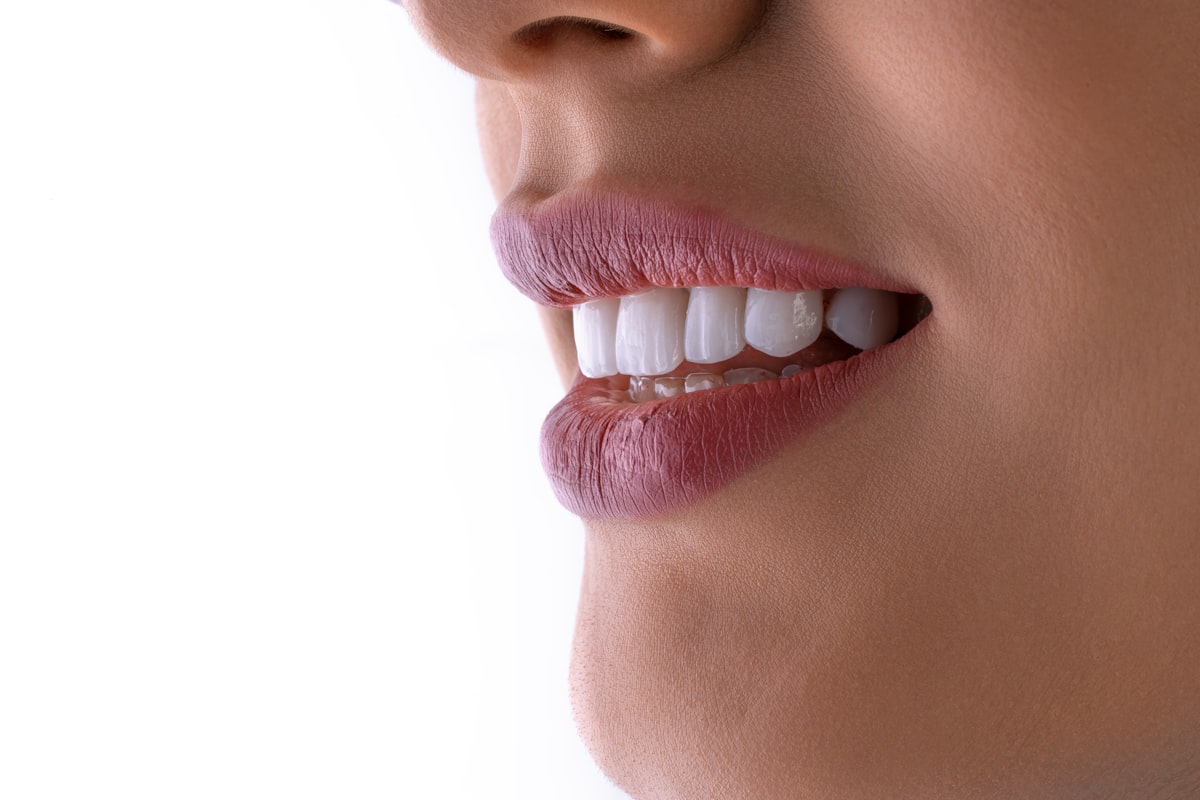 Smile Makeover